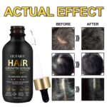 5% Minoxidil Hair Growth Serum for Men & Women - for Stronger Thicker Longer, Hair Regrowth Treatment- 2.02 oz - Image 2