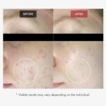 Red BHA Gel, AHA PHA LHA Exfoliating for Blemish-Prone Skin - Image 3