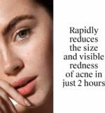 Neutrogena Rapid Clear Stubborn Acne Spot Treatment Gel, 1 oz - Image 6