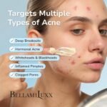 BellamiLuxx Cystic Acne Treatment for Face: Hormonal Acne Treatment Cream for Teens & Adults - Salicylic Acid & Tea Tree Oil Pimple Spot Remover - Anti-Acne Moisturizer Reduces Redness, Blemishes - Image 3