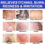 Folliculitis Care & Cystic Acne Cream for Face and Body – 1% Salicylic Acid - Image 6